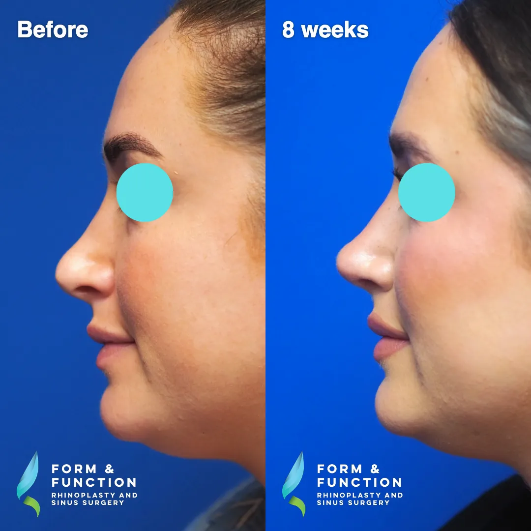Before and after, 8 weeks after revision rhinoplasty with septal reconstruction (photograph 4 of 8)