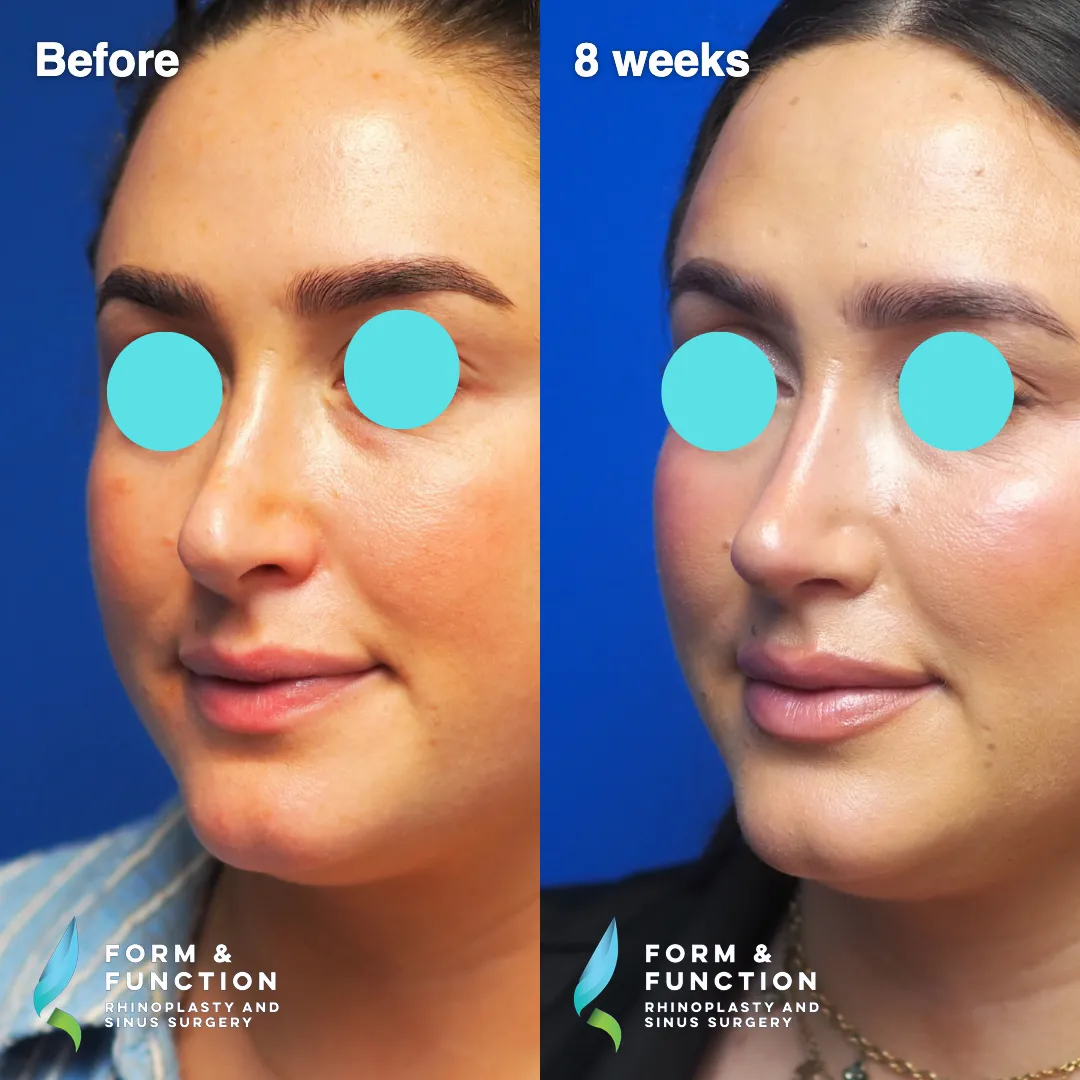 Before and after, right three-quarter view, 8 weeks after revision rhinoplasty with septal reconstruction