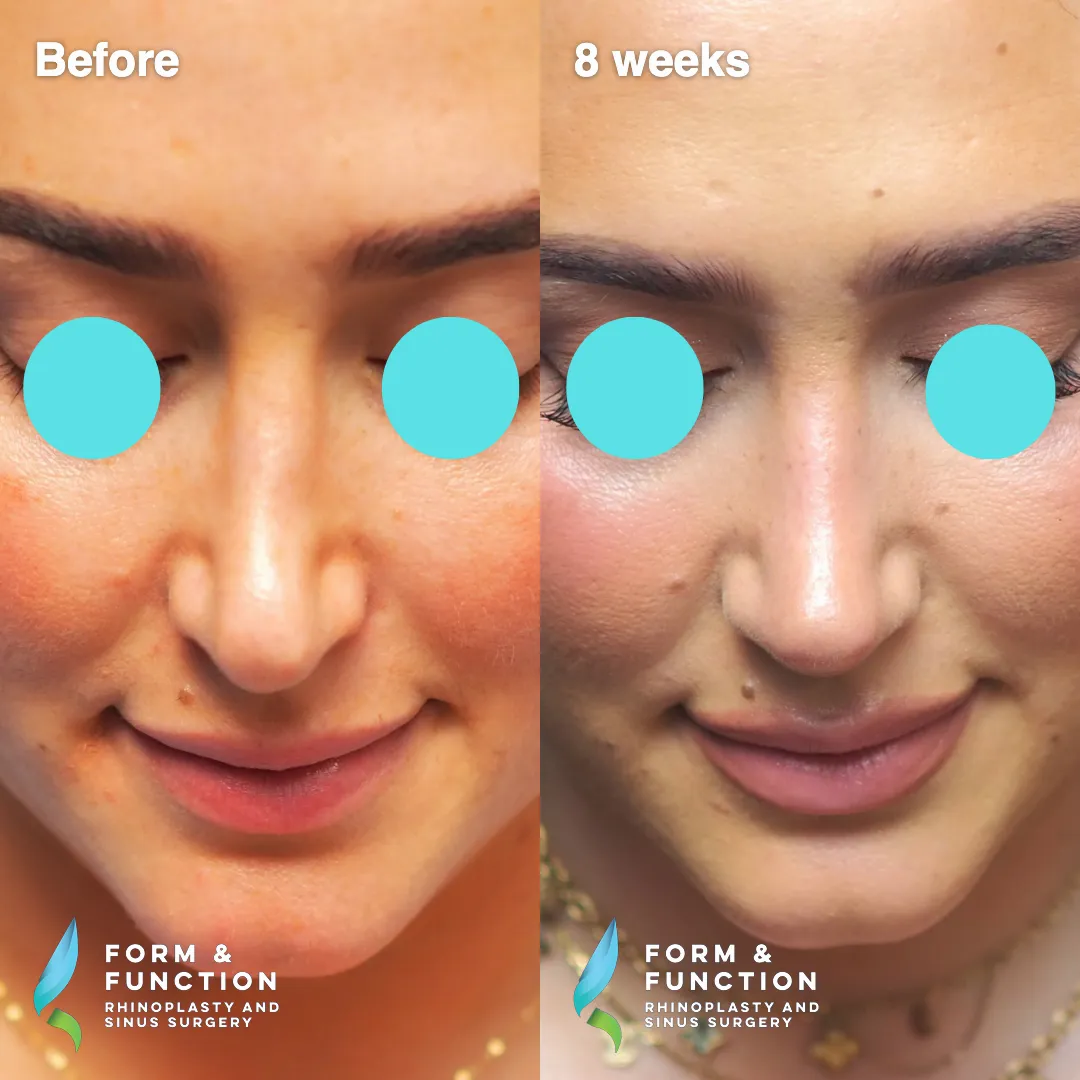 Before and after, left profile, 8 weeks after revision rhinoplasty with septal reconstruction
