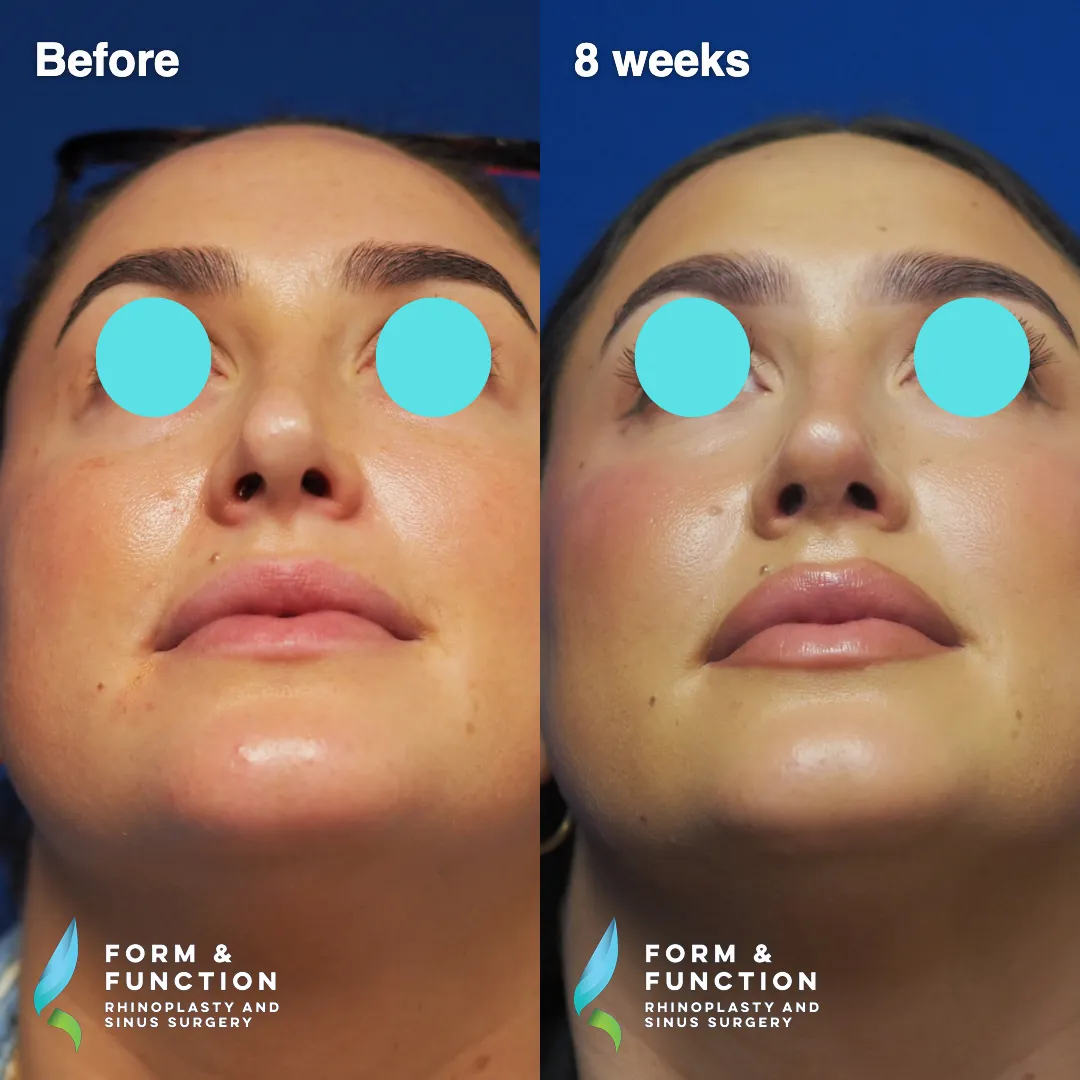 Before and after, 8 weeks after revision rhinoplasty with septal reconstruction (photograph 7 of 8)
