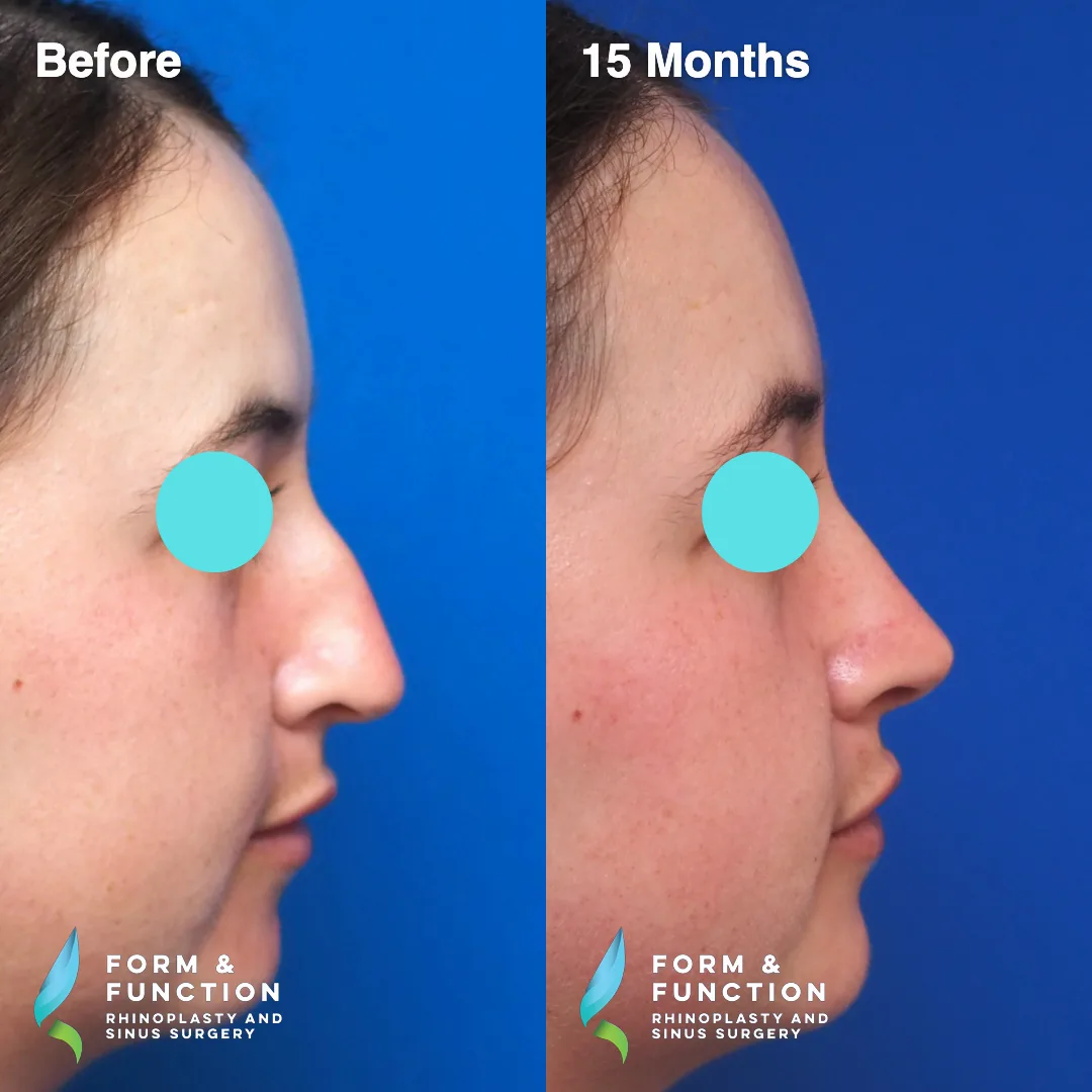 Before and after, left three-quarter view, 15 months after rhinoplasty and septoplasty