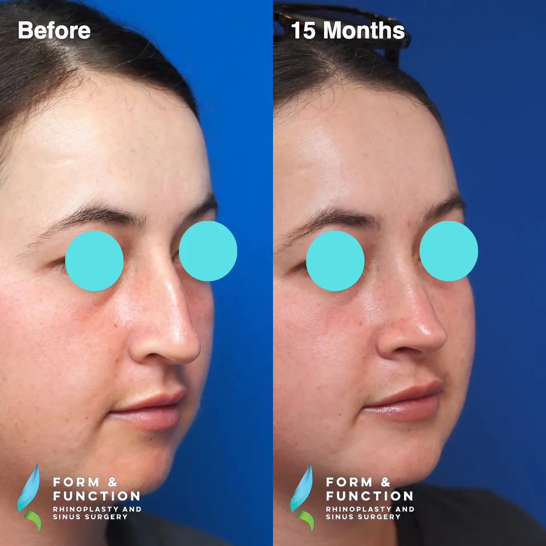 Before and after, right profile, 15 months after rhinoplasty and septoplasty