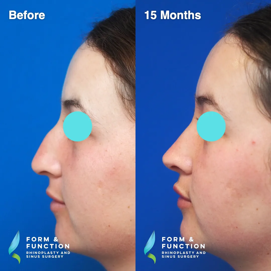 Before and after, 15 months after rhinoplasty and septoplasty (photograph 3 of 6)
