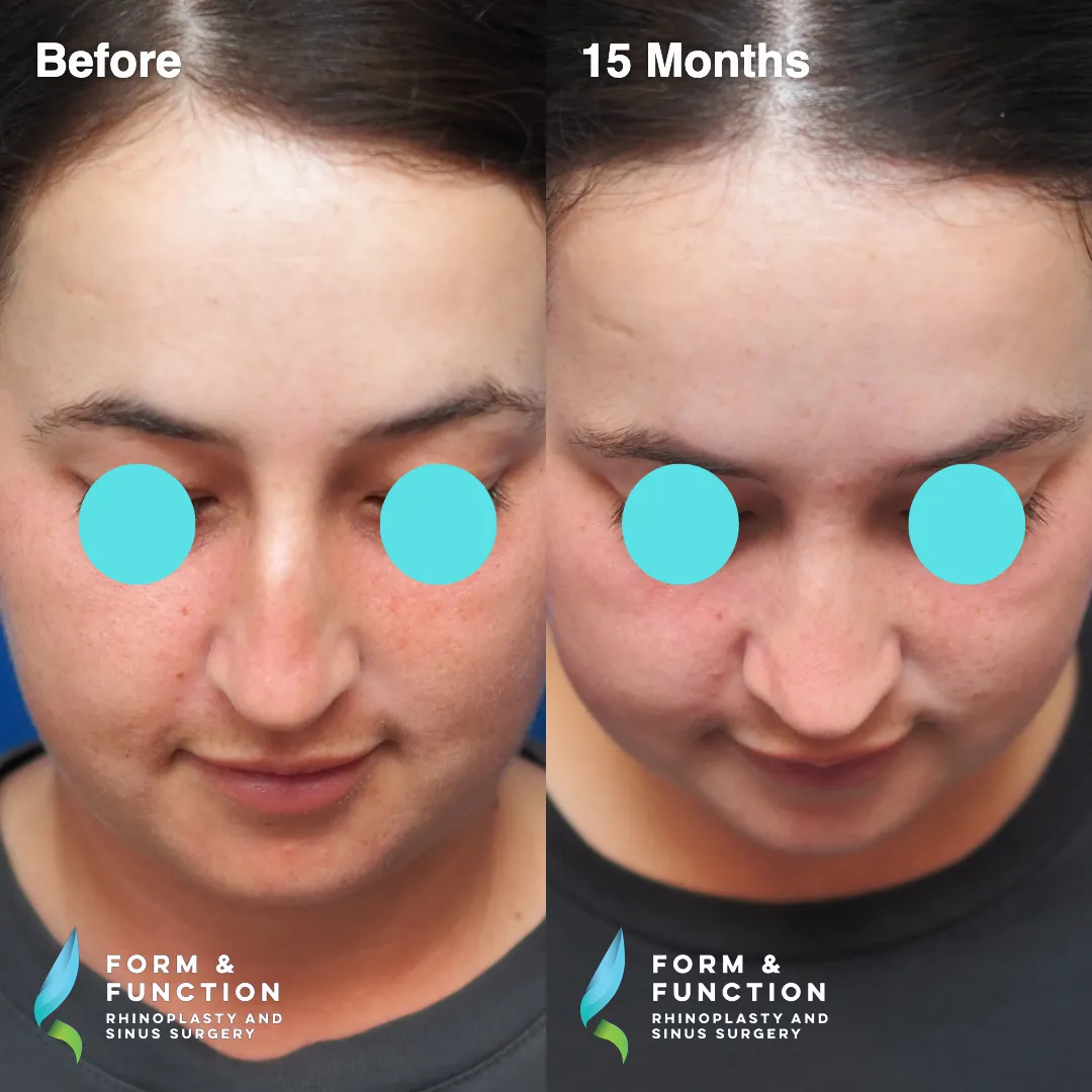 Before and after, frontal view, 15 months after rhinoplasty and septoplasty