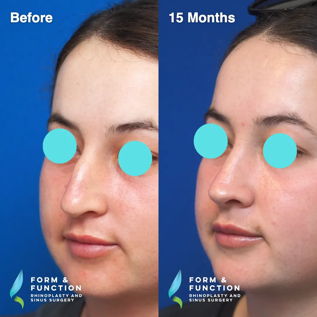 Before and after, 15 months after rhinoplasty and septoplasty (photograph 5 of 6)