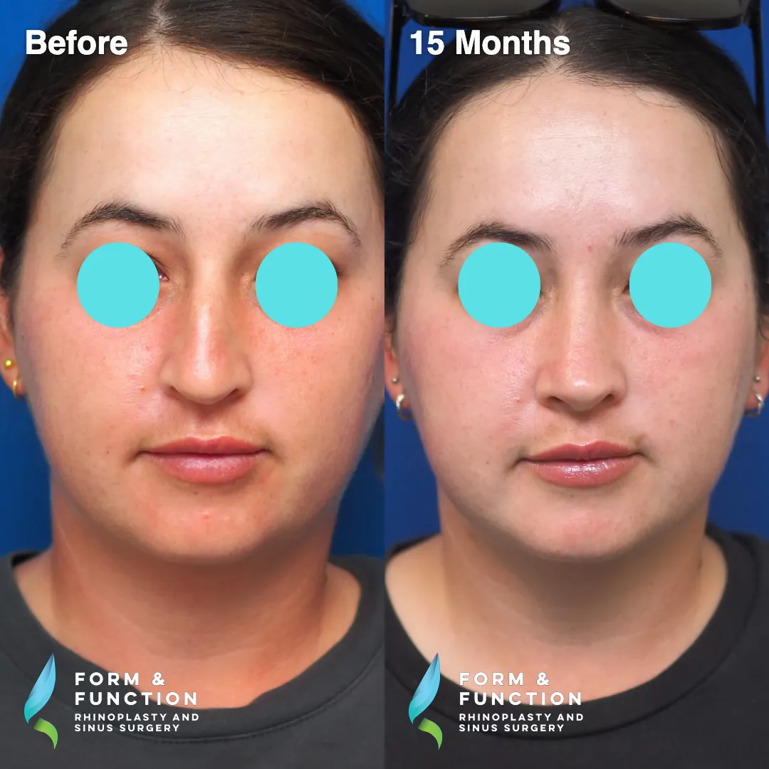 Before and after, 15 months after rhinoplasty and septoplasty (photograph 6 of 6)
