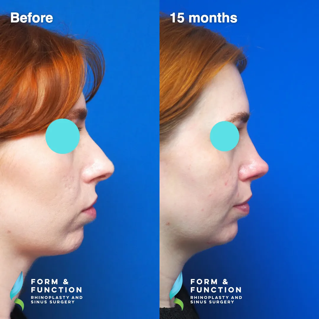 Before and after, frontal view, 15 months after rhinoplasty and septoplasty