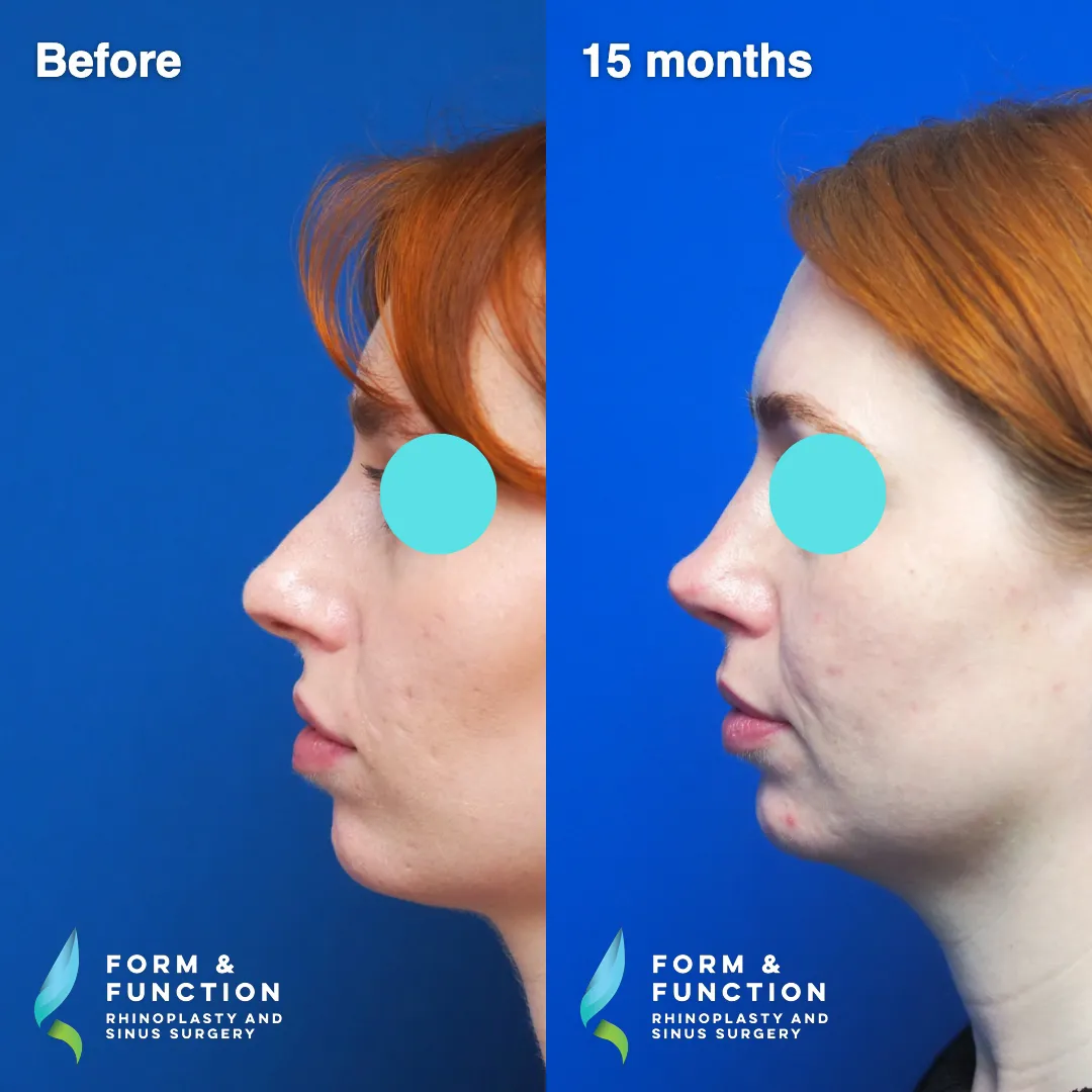 Before and after, left three-quarter view, 15 months after rhinoplasty and septoplasty