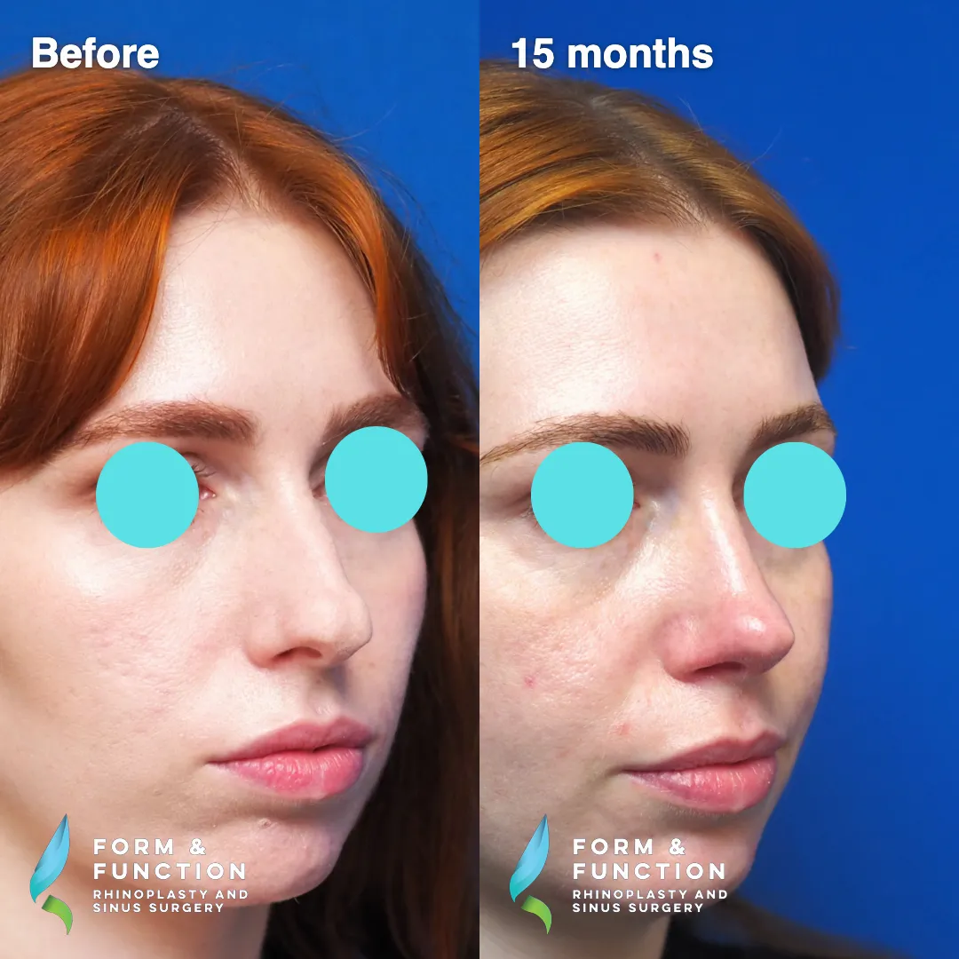 Before and after, 15 months after rhinoplasty and septoplasty (photograph 3 of 7)