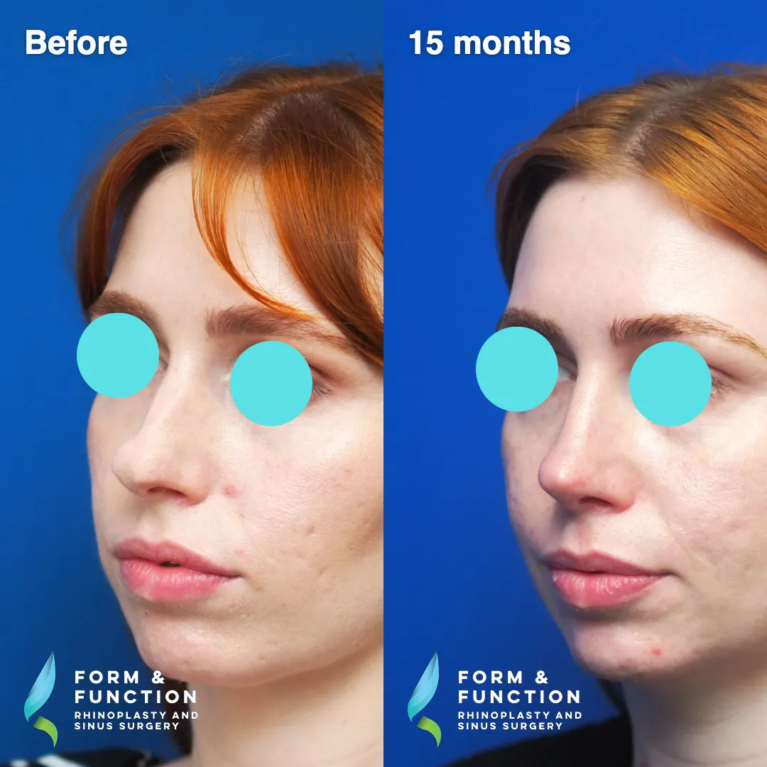 Before and after, base view, 15 months after rhinoplasty and septoplasty