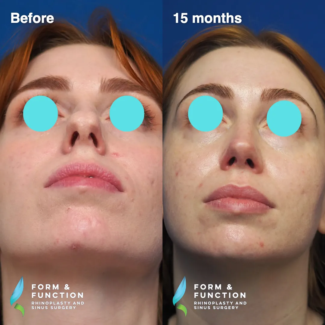 Before and after, left profile, 15 months after rhinoplasty and septoplasty
