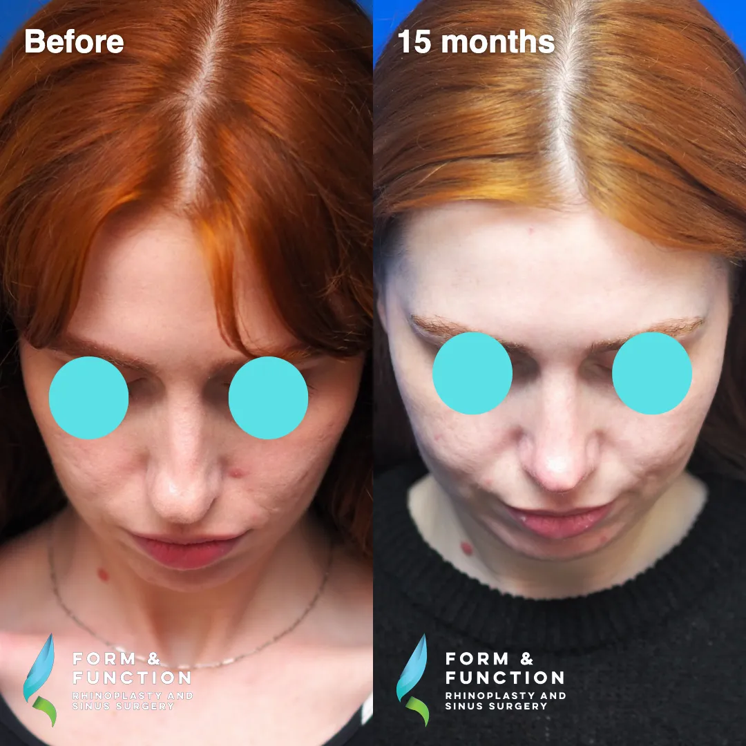 Before and after, 15 months after rhinoplasty and septoplasty (photograph 6 of 7)