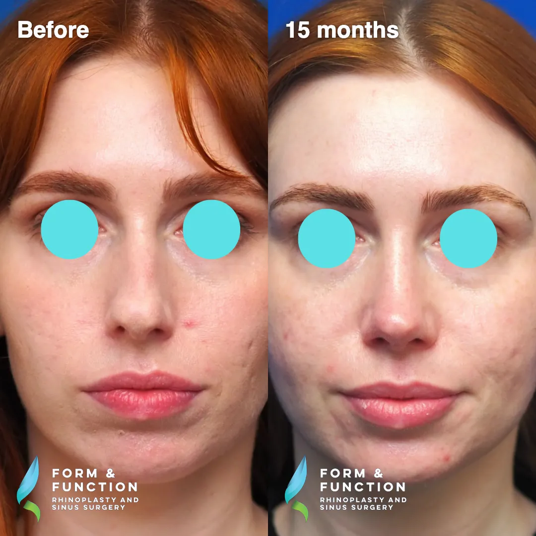 Before and after, 15 months after rhinoplasty and septoplasty (photograph 7 of 7)