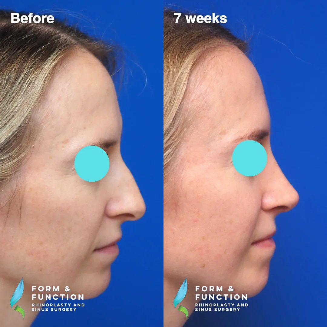 Before and after, left profile, 7 weeks after rhinoplasty and septoplasty
