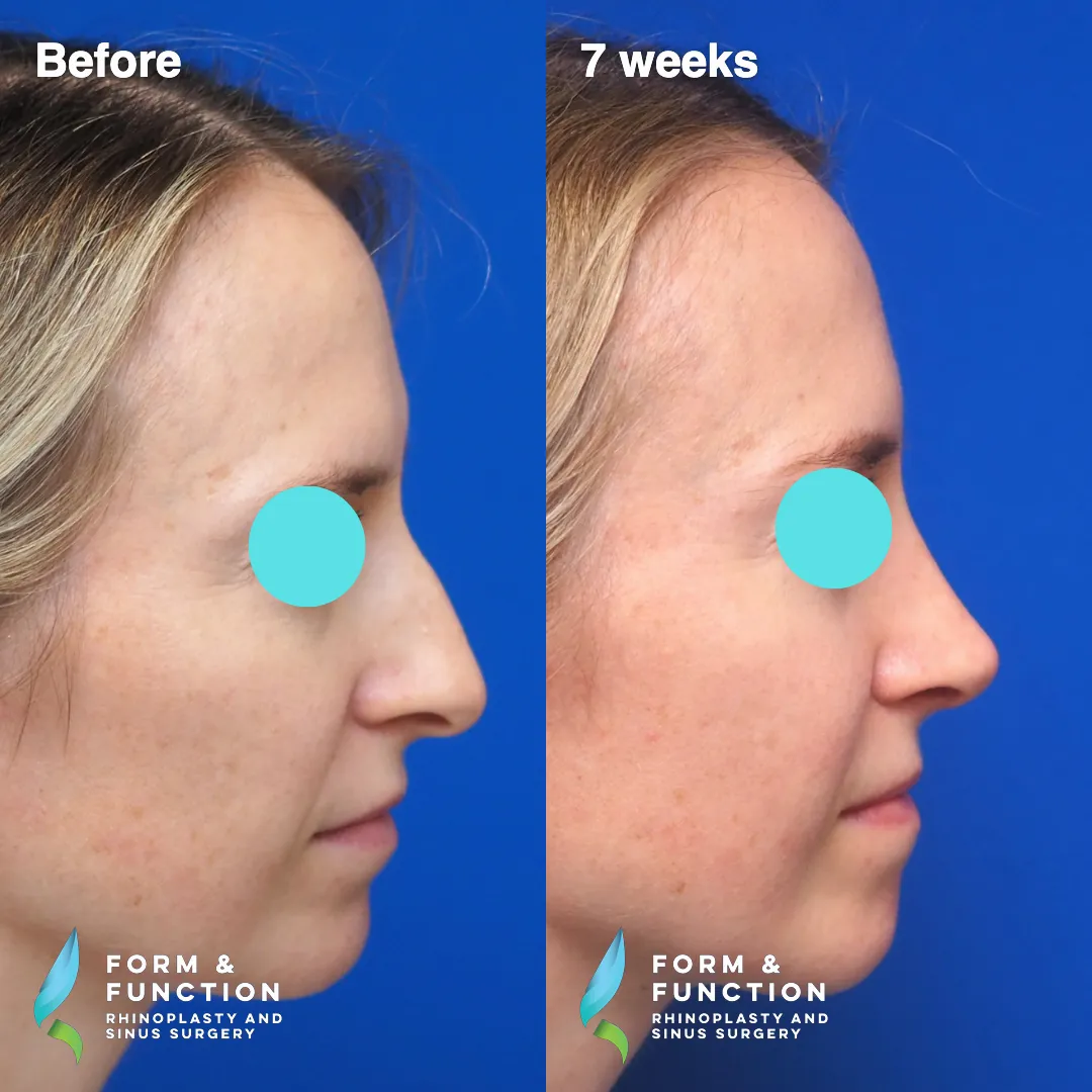 Before and after, left profile, 7 weeks after rhinoplasty and septoplasty