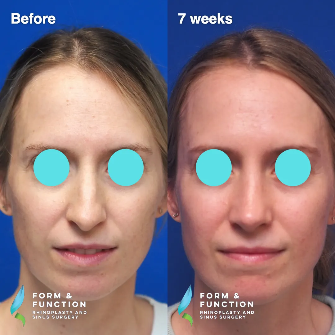 Before and after, 7 weeks after rhinoplasty and septoplasty (photograph 2 of 6)