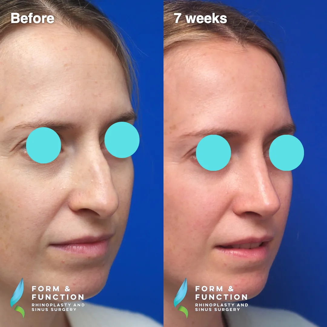 Before and after, left three-quarter view, 7 weeks after rhinoplasty and septoplasty