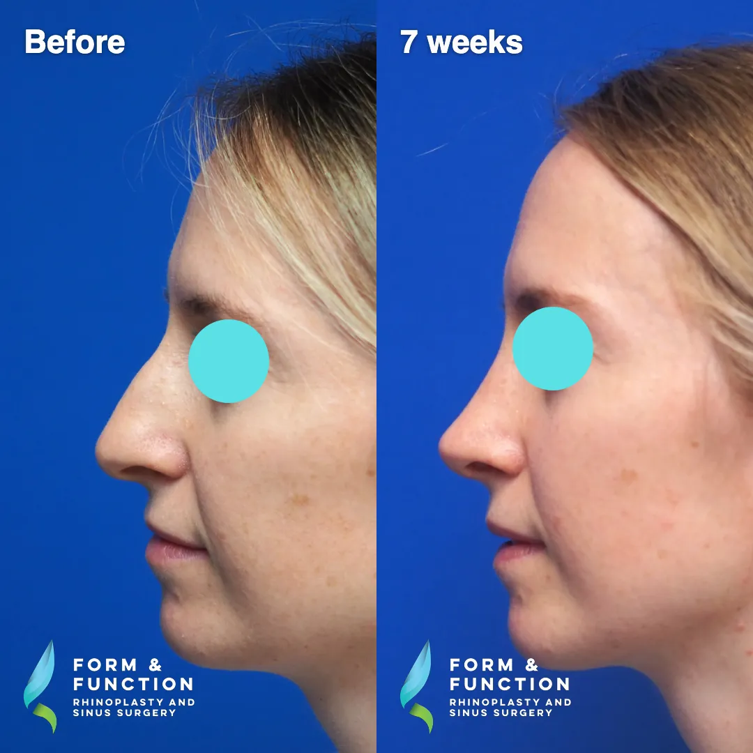 Before and after, 7 weeks after rhinoplasty and septoplasty (photograph 4 of 6)
