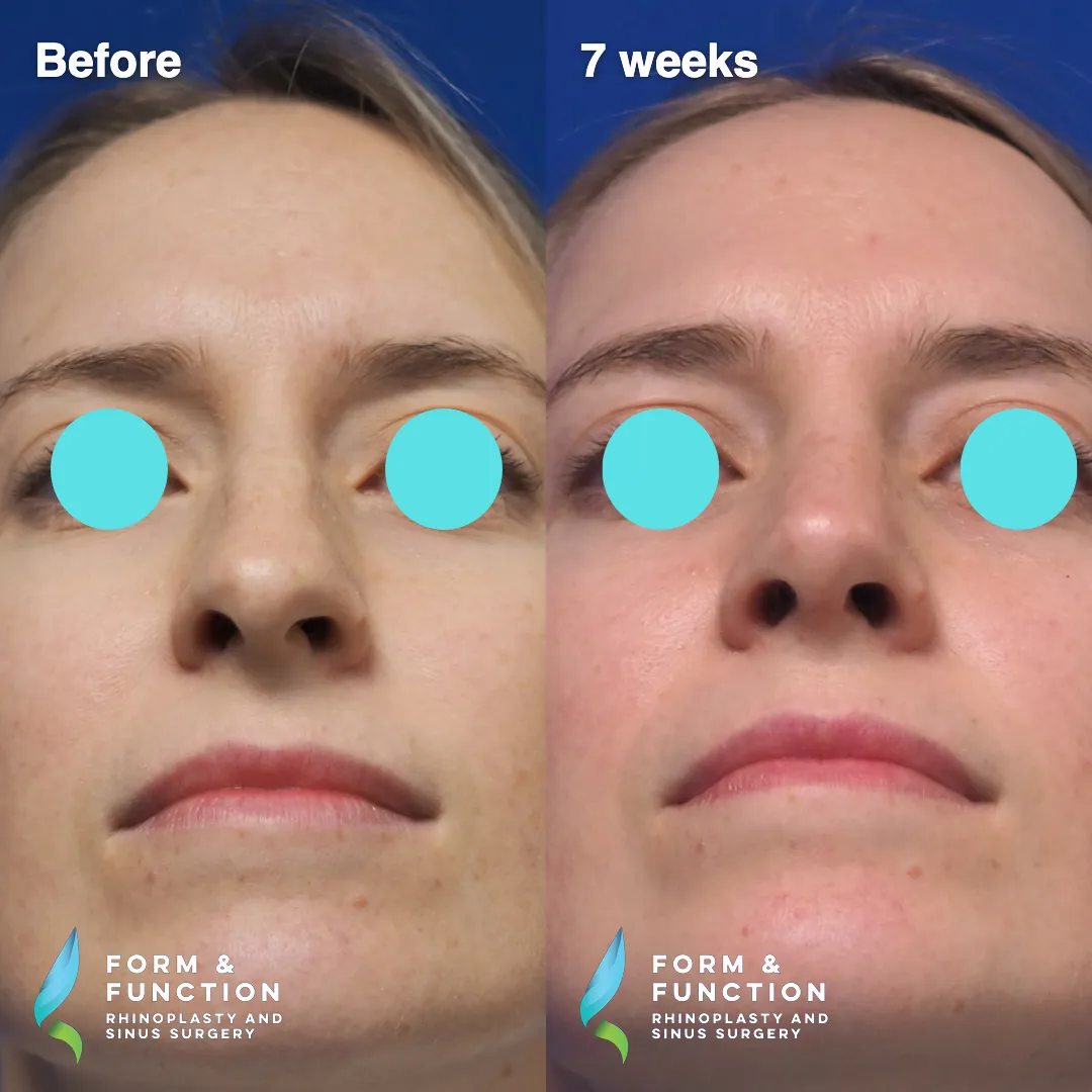 Before and after, base view, 7 weeks after rhinoplasty and septoplasty
