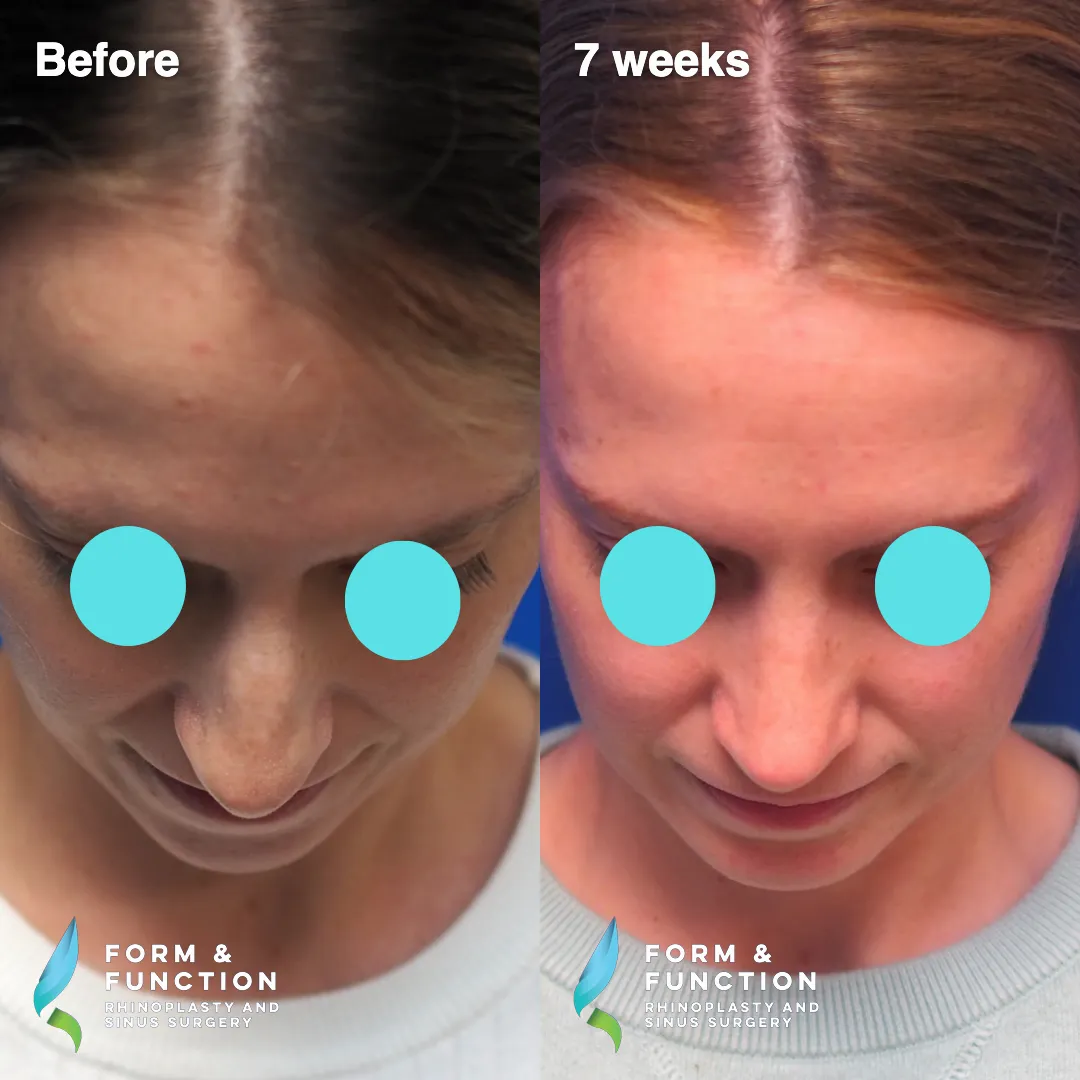 Before and after, 7 weeks after rhinoplasty and septoplasty (photograph 6 of 6)
