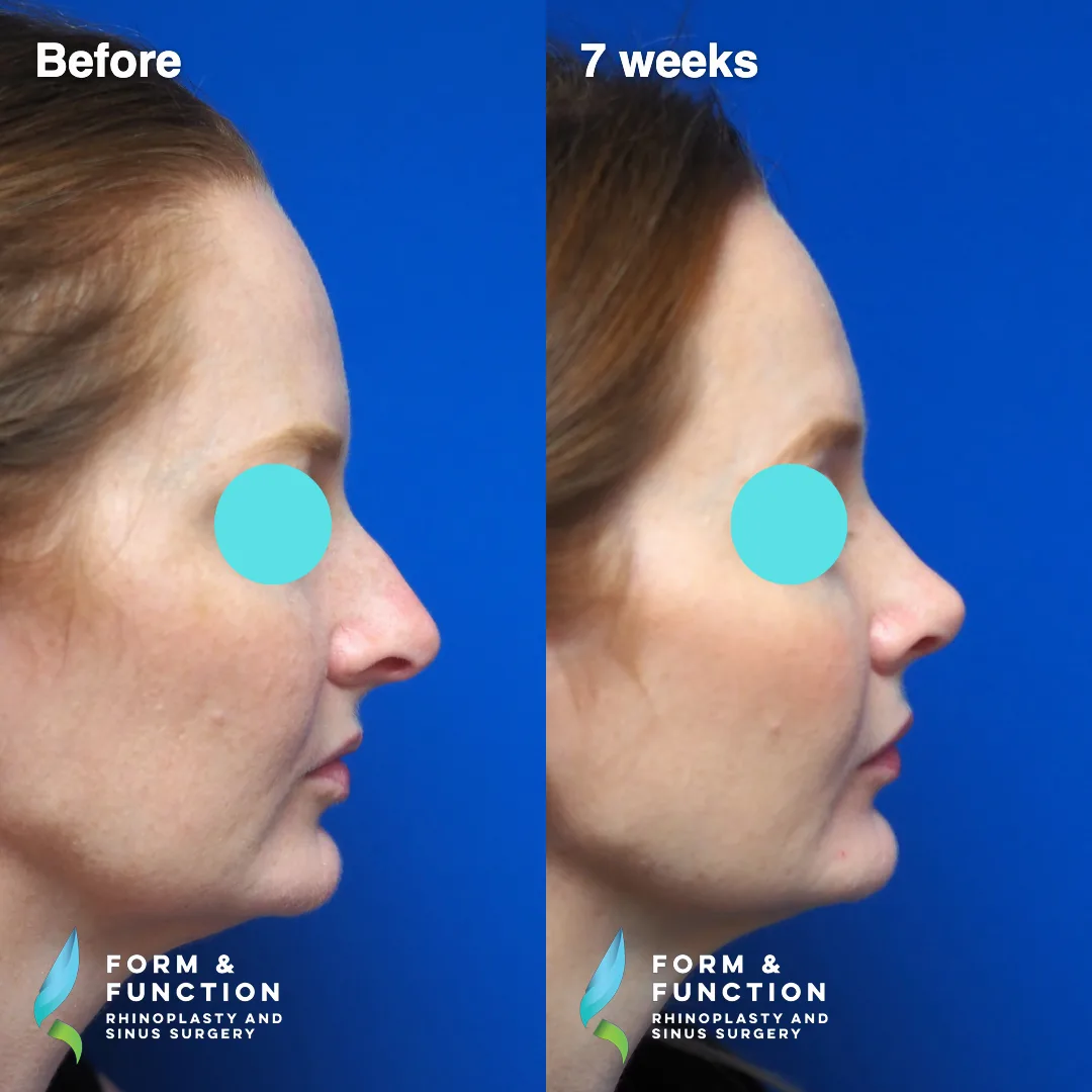 Before and after, 7 weeks after septorhinoplasty (photograph 1 of 7)