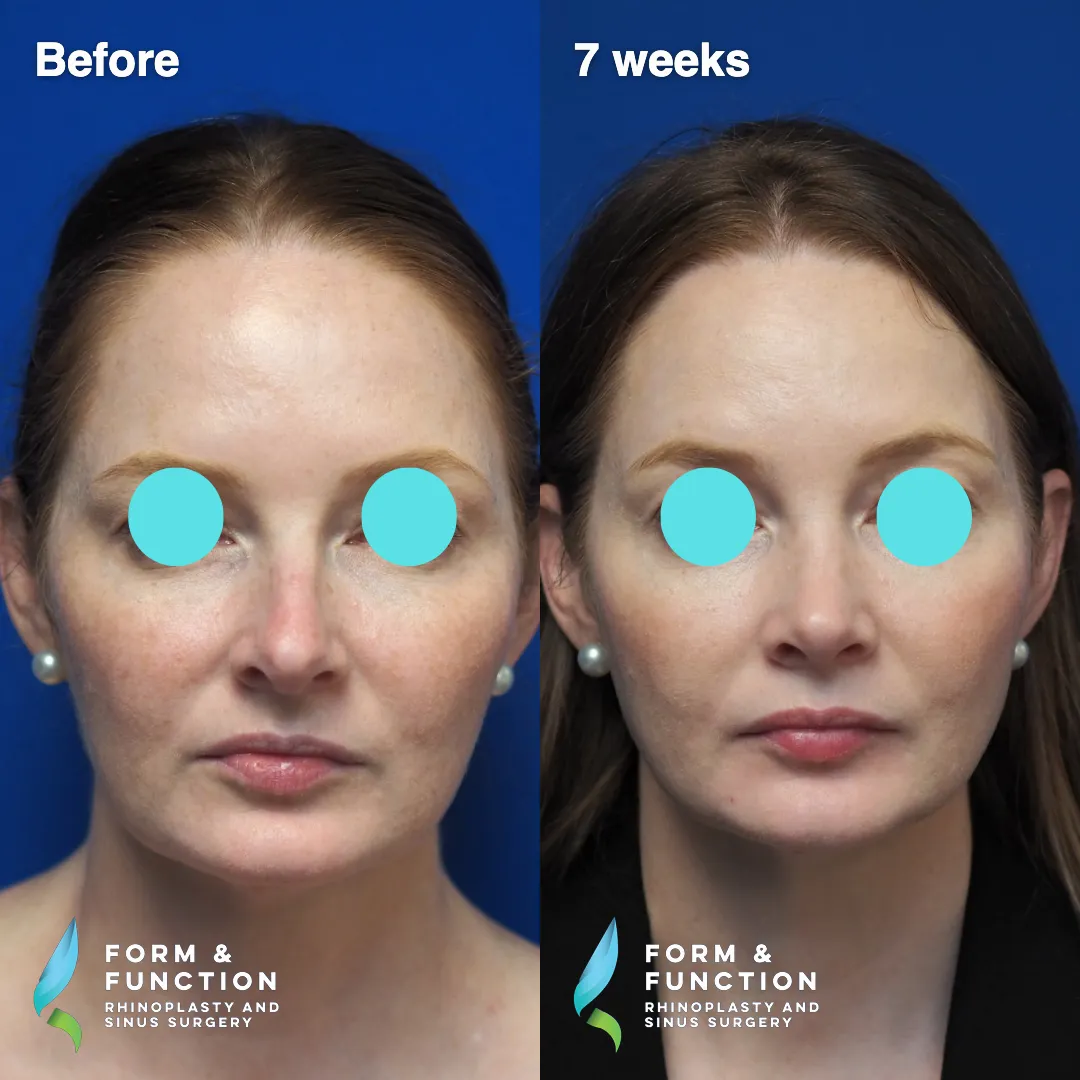Before and after, 7 weeks after septorhinoplasty (photograph 2 of 7)