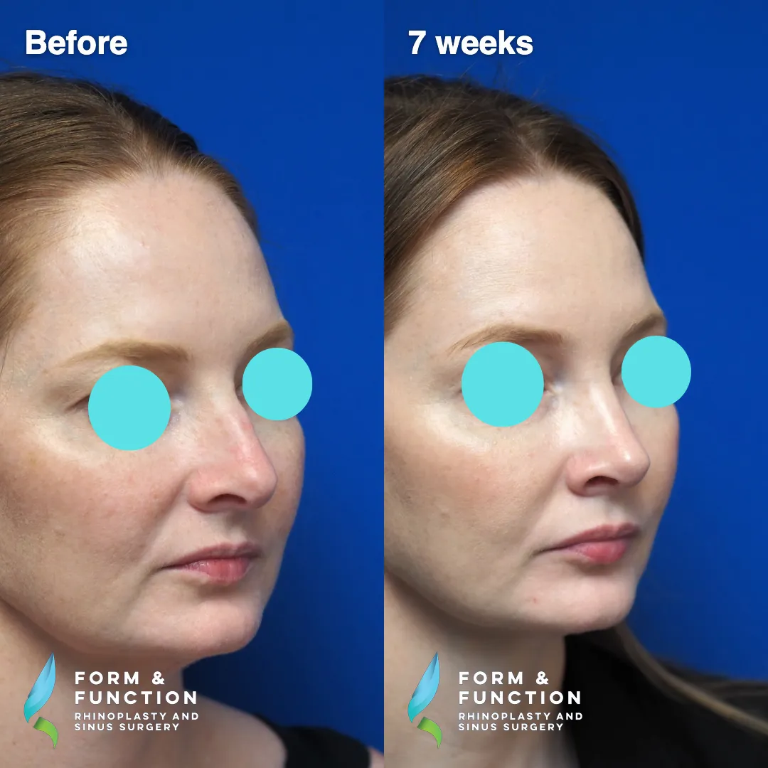 Before and after, 7 weeks after septorhinoplasty (photograph 3 of 7)
