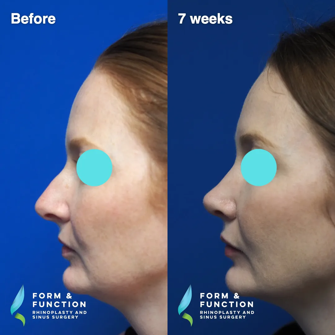 Before and after, 7 weeks after septorhinoplasty (photograph 4 of 7)