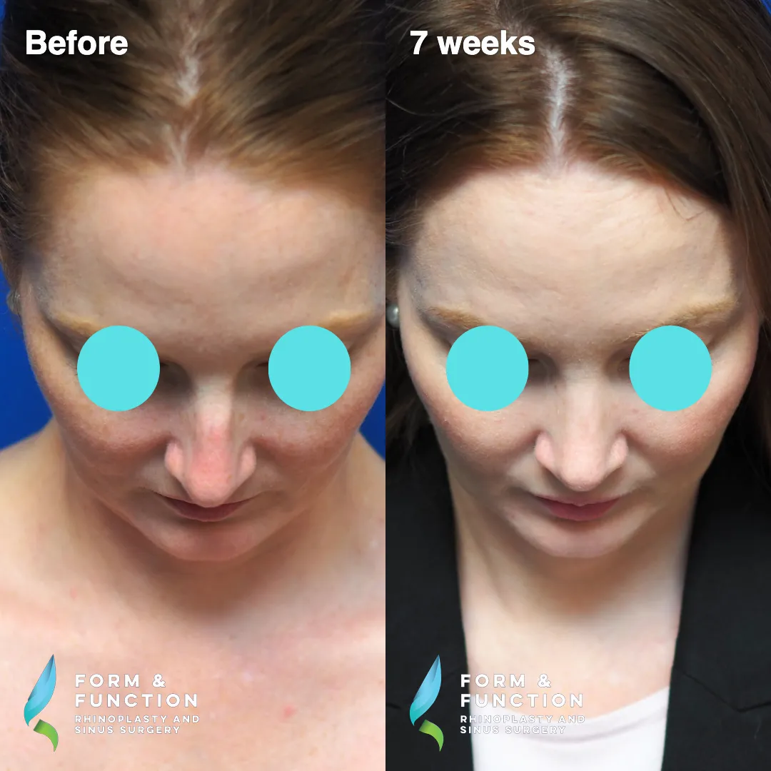 Before and after, 7 weeks after septorhinoplasty (photograph 5 of 7)