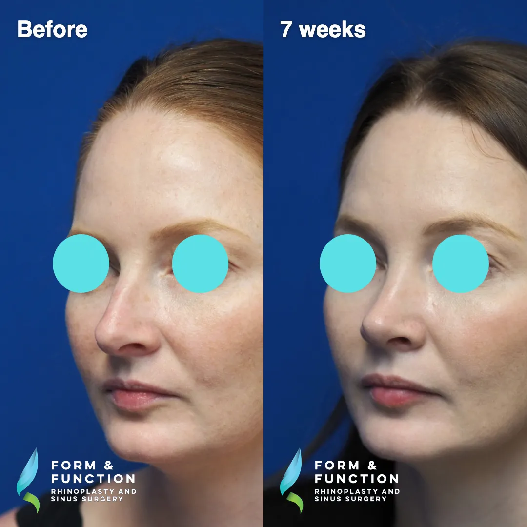 Before and after, 7 weeks after septorhinoplasty (photograph 6 of 7)
