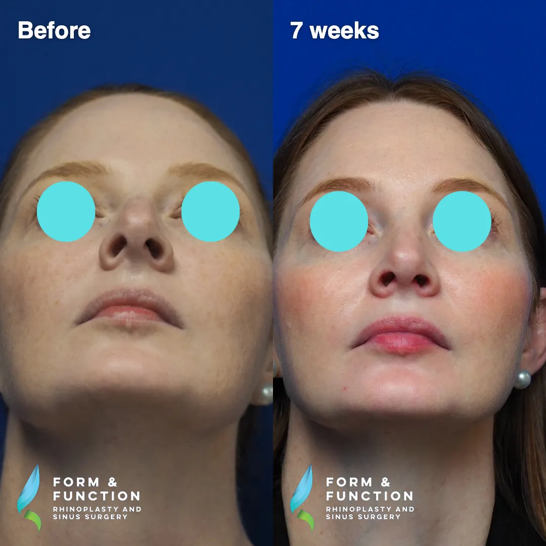 Before and after, 7 weeks after septorhinoplasty (photograph 7 of 7)