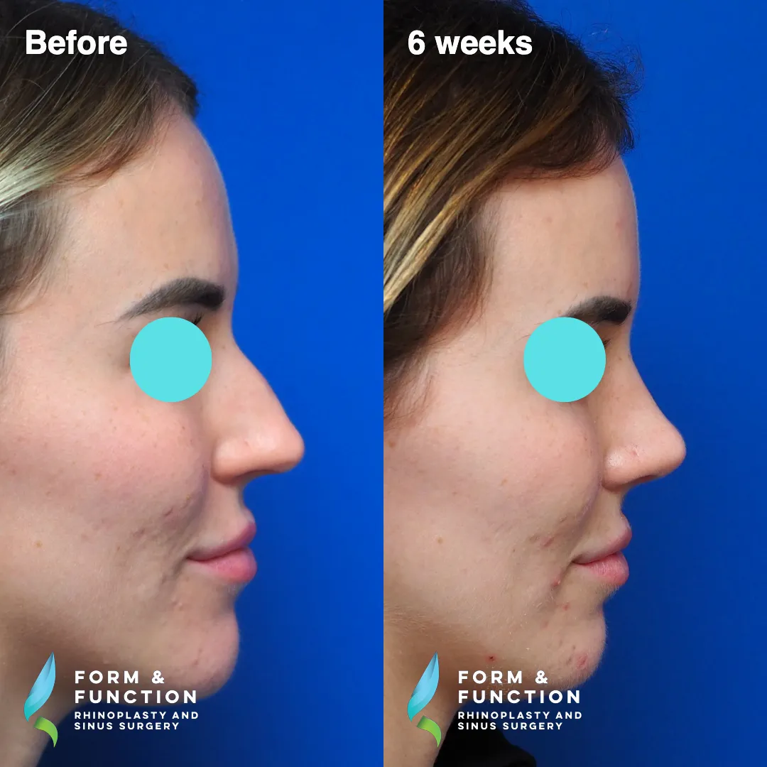 Before and after, 6 weeks after rhinoplasty and septoplasty (photograph 1 of 6)