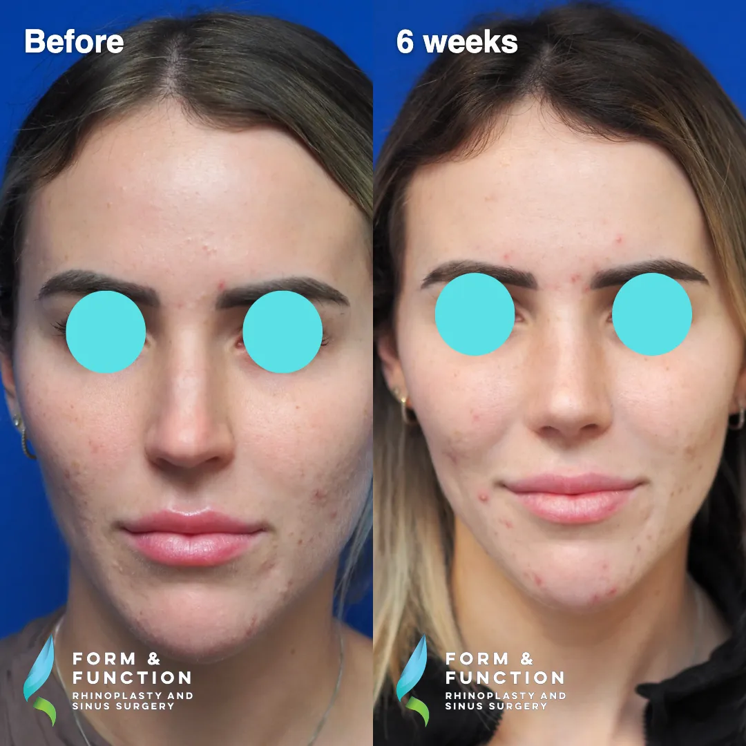 Before and after, 6 weeks after rhinoplasty and septoplasty (photograph 2 of 6)