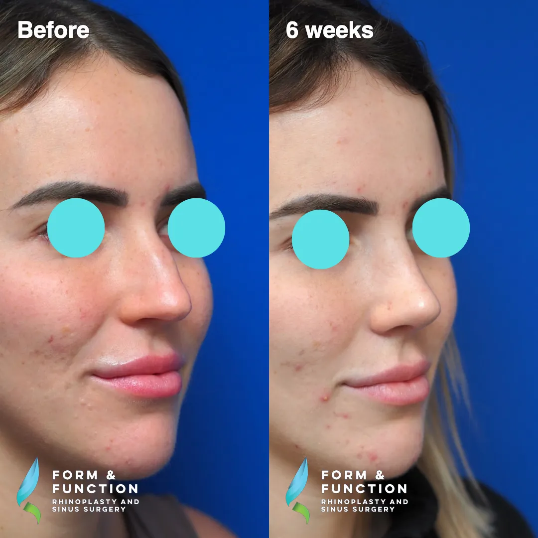 Before and after, 6 weeks after rhinoplasty and septoplasty (photograph 3 of 6)