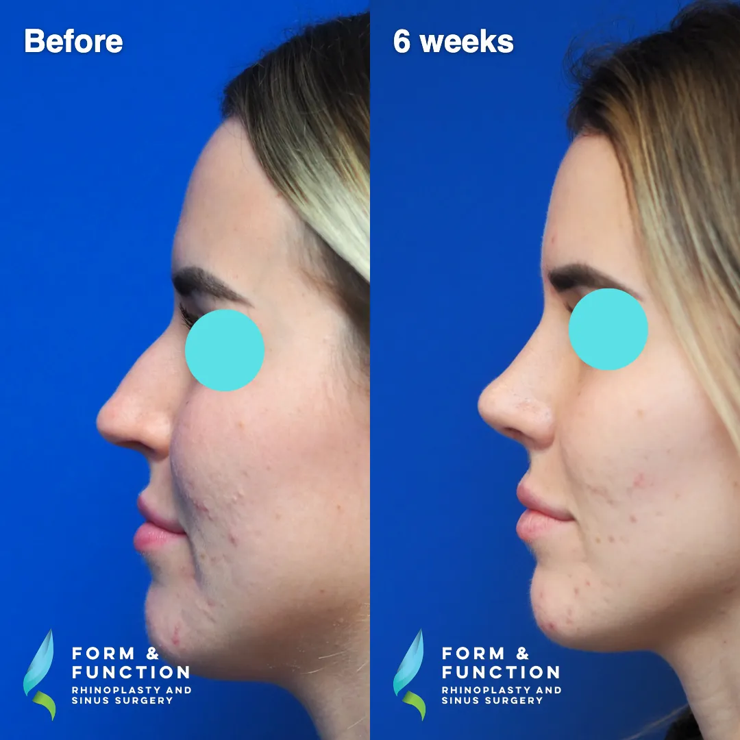 Before and after, 6 weeks after rhinoplasty and septoplasty (photograph 4 of 6)