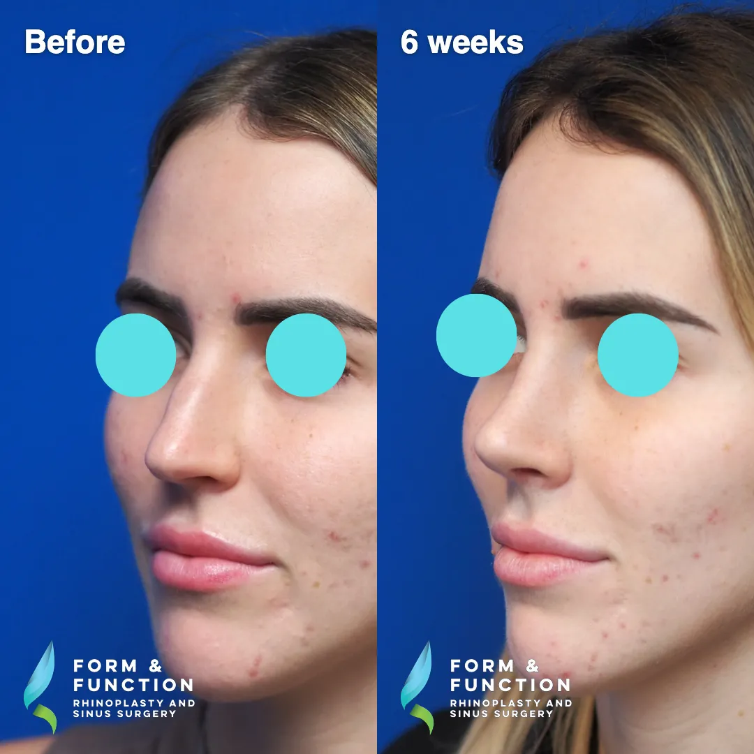 Before and after, 6 weeks after rhinoplasty and septoplasty (photograph 5 of 6)