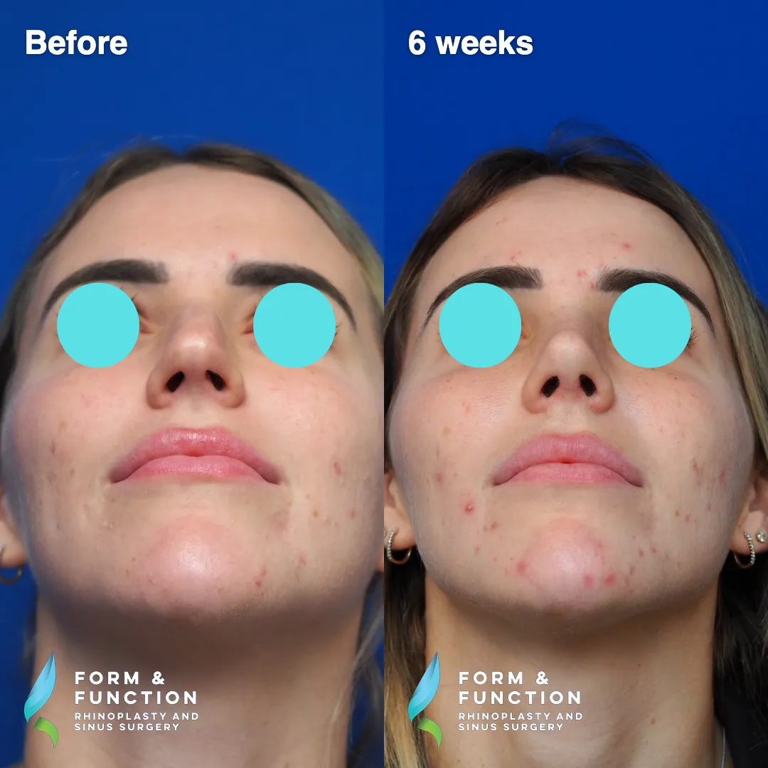 Before and after, 6 weeks after rhinoplasty and septoplasty (photograph 6 of 6)