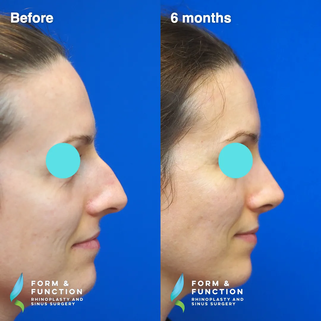 Before and after, 6 months after rhinoplasty with septal reconstruction (photograph 1 of 6)