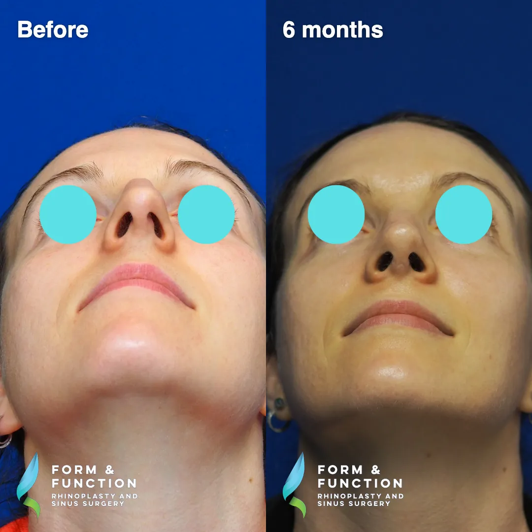 Before and after, 6 months after rhinoplasty with septal reconstruction (photograph 2 of 6)