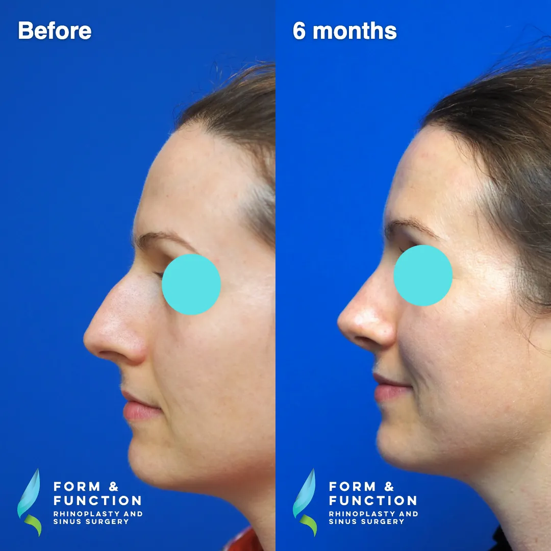 Before and after, 6 months after rhinoplasty with septal reconstruction (photograph 3 of 6)