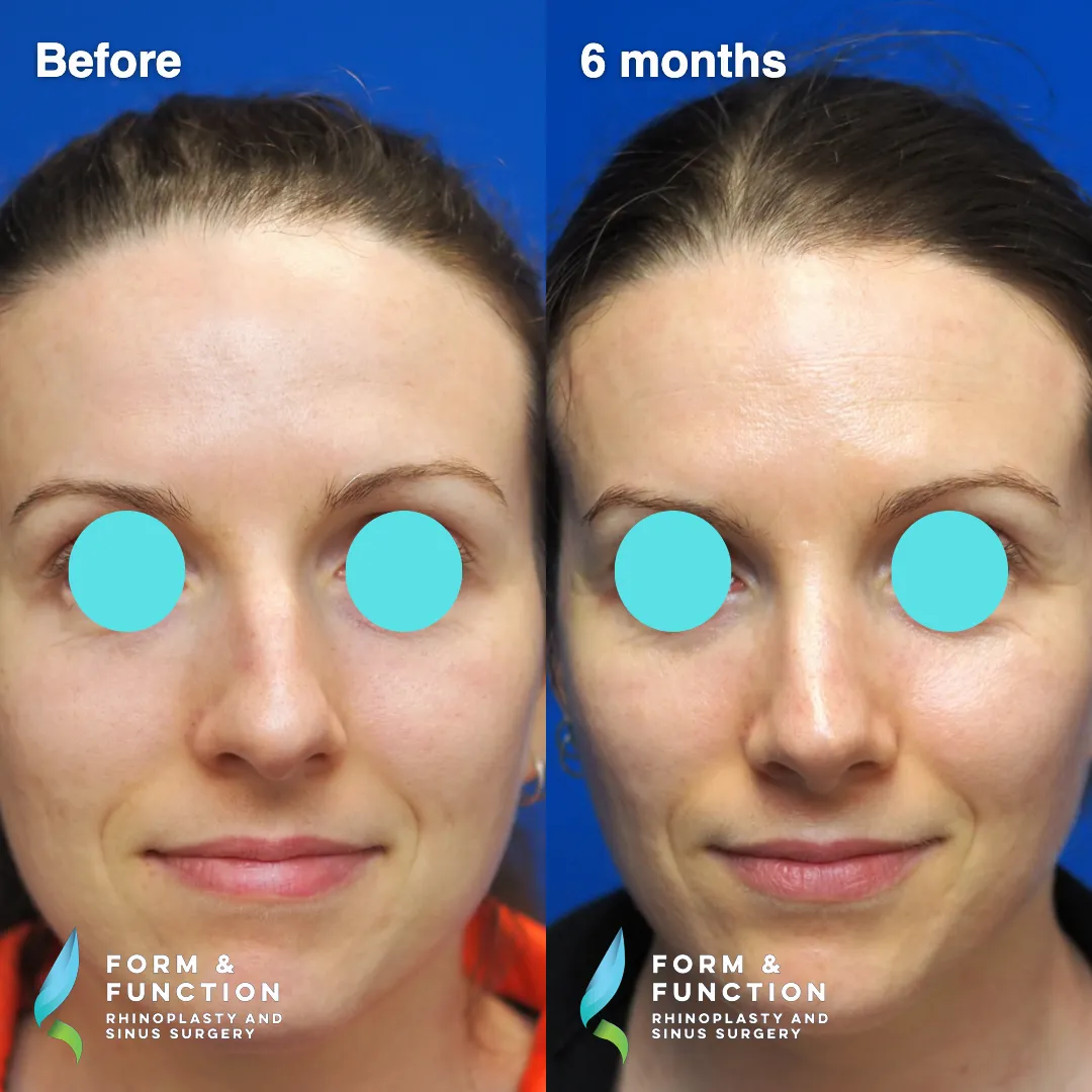 Before and after, 6 months after rhinoplasty with septal reconstruction (photograph 4 of 6)