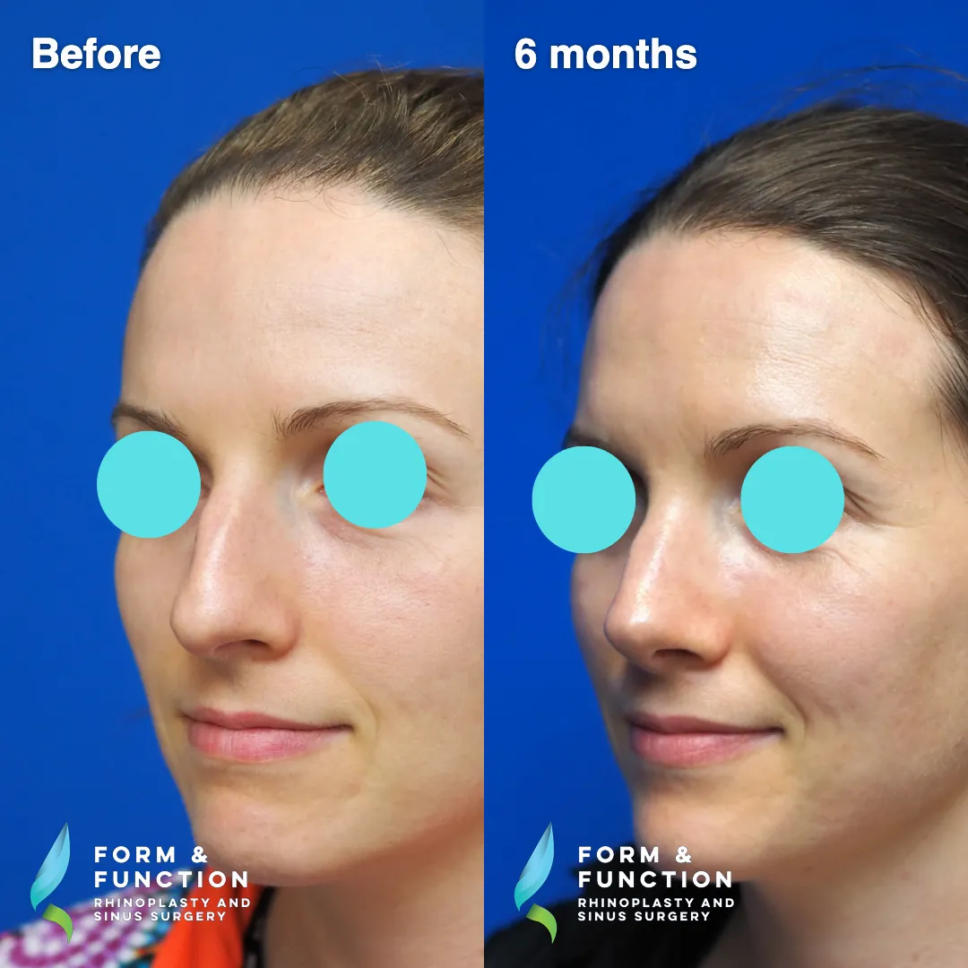 Before and after, 6 months after rhinoplasty with septal reconstruction (photograph 5 of 6)