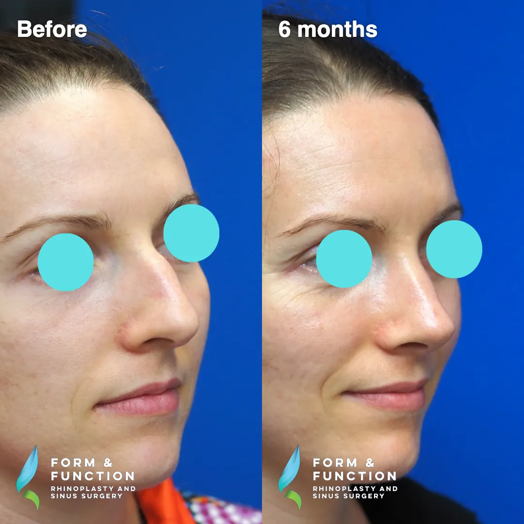 Before and after, 6 months after rhinoplasty with septal reconstruction (photograph 6 of 6)