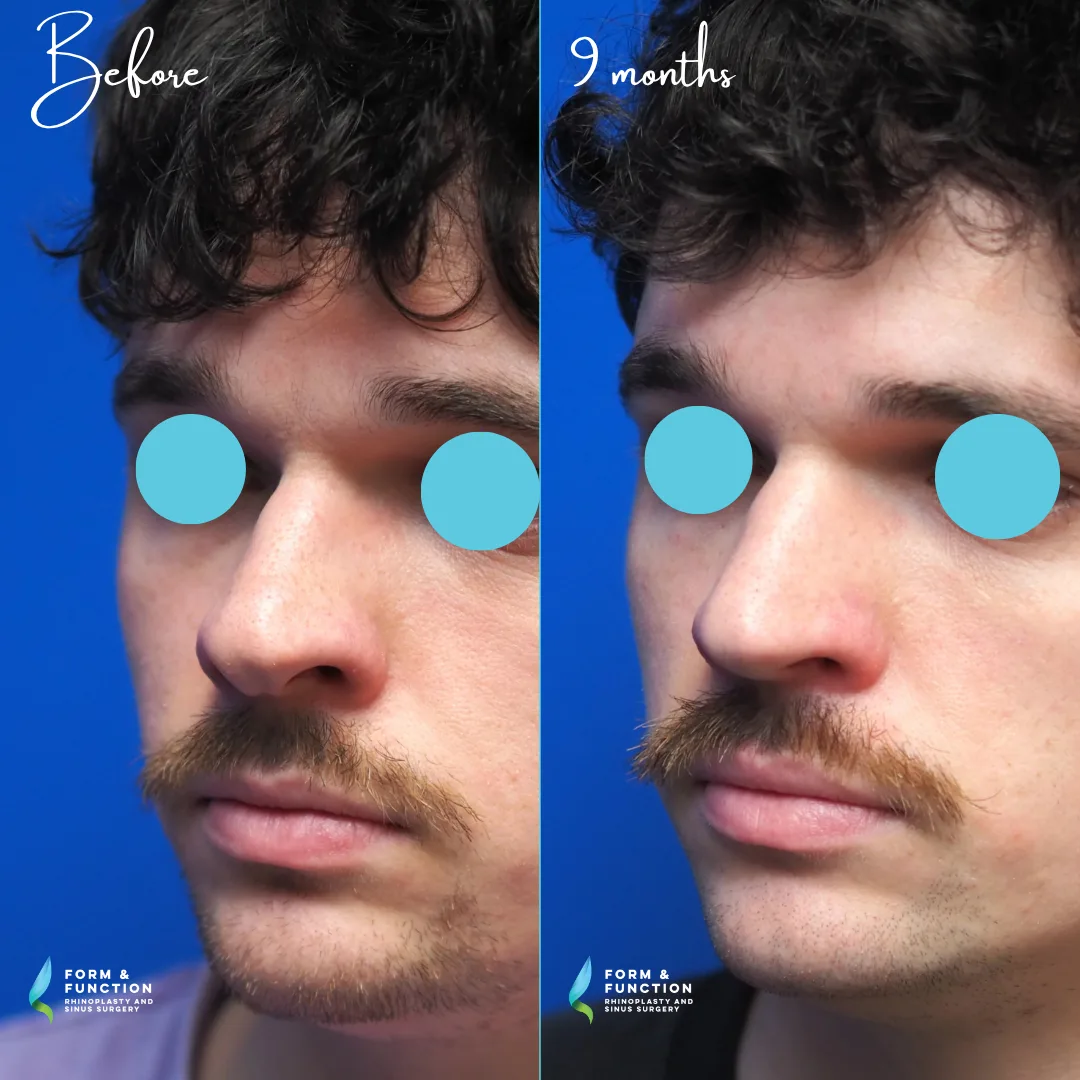 Before and after, 9 months after rhinoplasty with septal reconstruction (rib graft) (photograph 1 of 7)