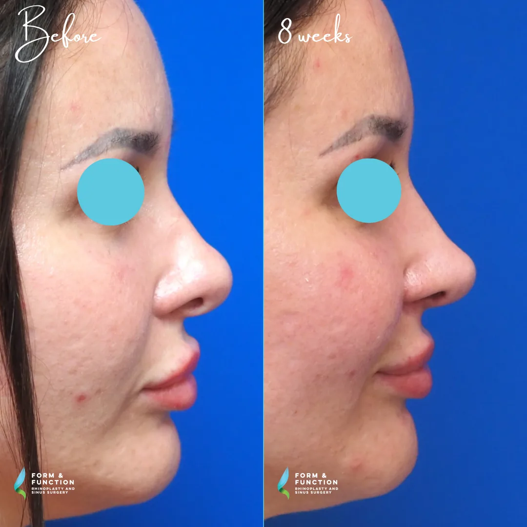 Before and after, 8 weeks after revision ultrasonic rhinoplasty with septal reconstruction (rib graft) (photograph 1 of 6)