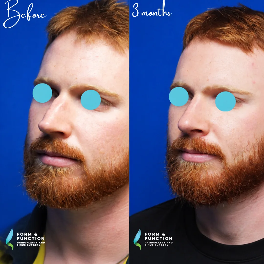Before and after, 3 months after ultrasonic rhinoplasty and septoplasty (photograph 1 of 7)