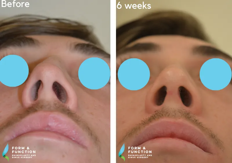 Before and after, 6 weeks after rhinoplasty (photograph 1 of 3)