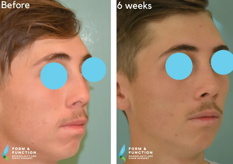 Before and after, 6 weeks after rhinoplasty (photograph 2 of 3)