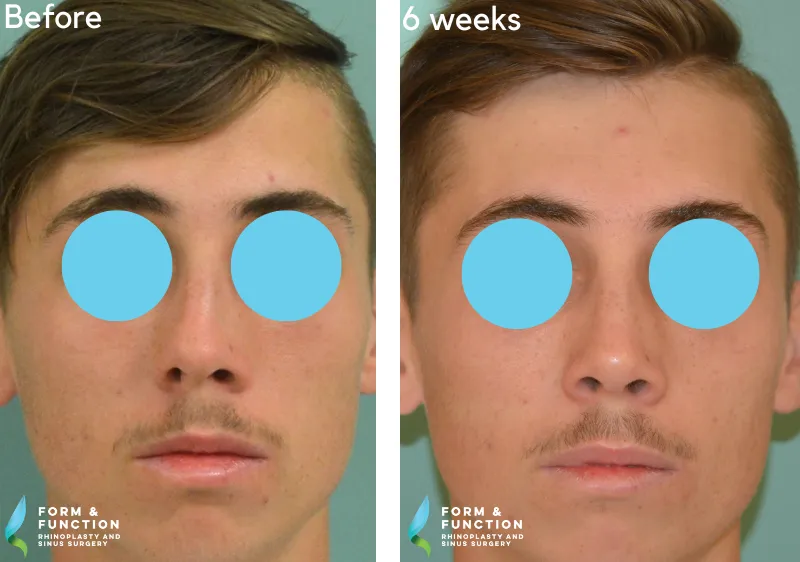 Before and after, 6 weeks after rhinoplasty (photograph 3 of 3)