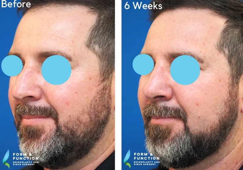 Before and after, 6 weeks after rhinoplasty (photograph 1 of 4)